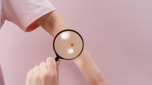 Vaccino melanoma, l'Istituto dei tumori di Milano primo per contributo al trial