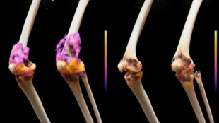 Artrite reumatoide, le cellule Car T efficaci sui casi difficili