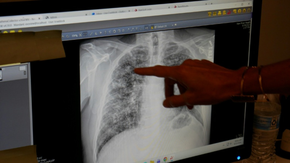 In US mining hub, black lung rates soar
